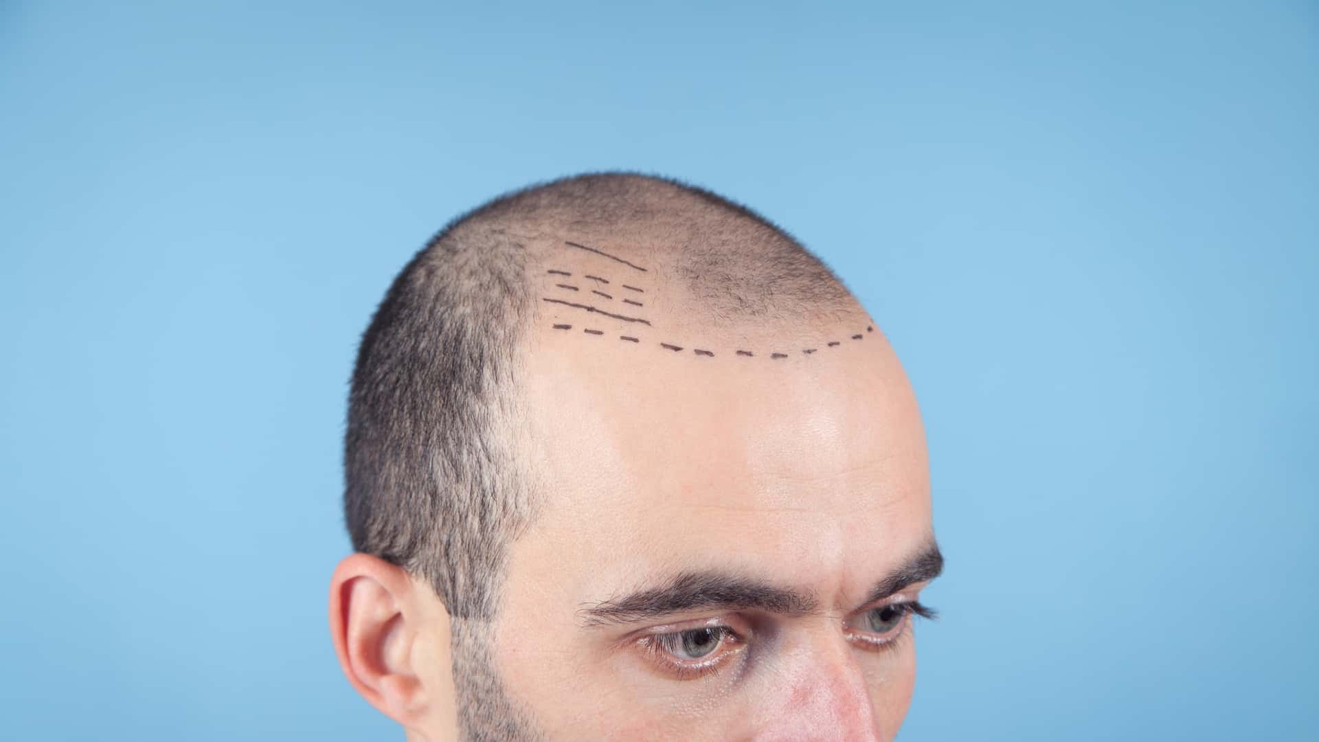 FUE Hair Transplant